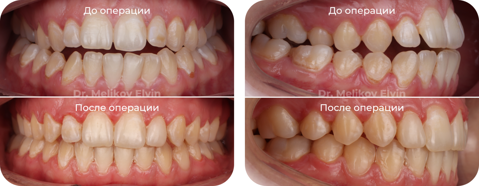 Фотографии прикуса до и после ортогнатической операции.