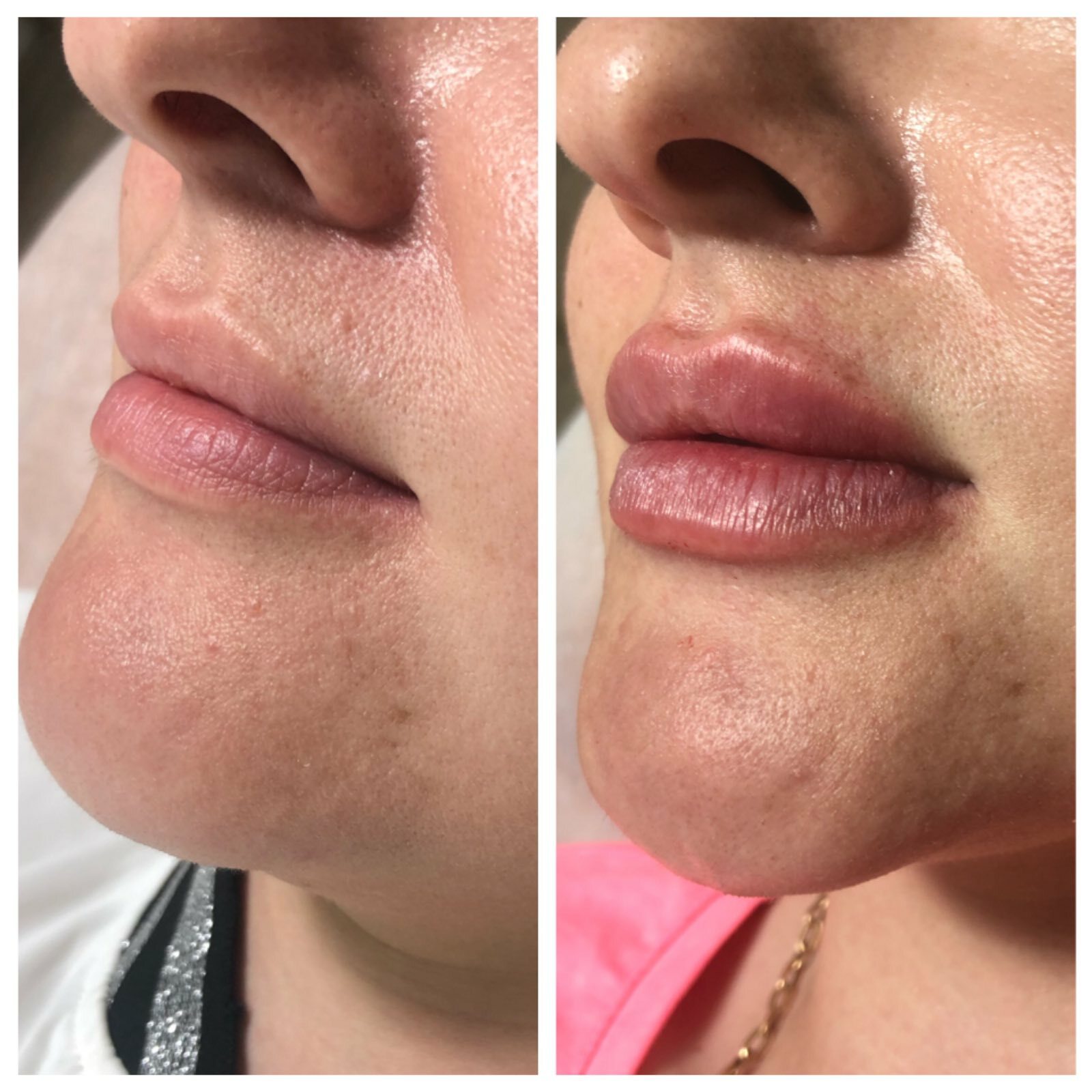 пудровые губы отзывы фото до и после