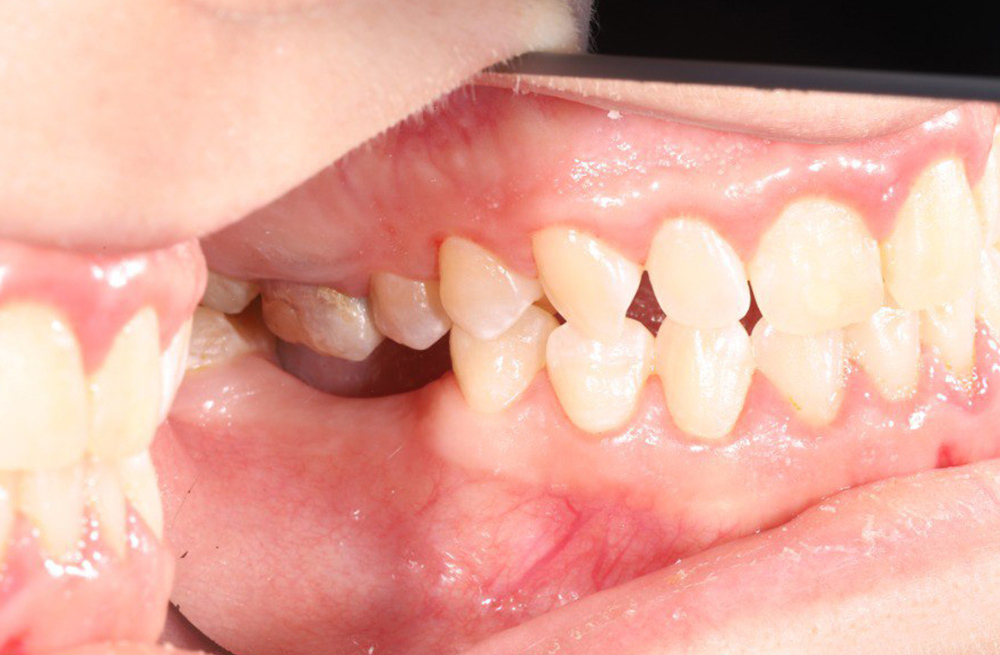 Удаление повреждённого жевательного зуба с имплантацией и реставрация соседнего зуба циркониевой коронкой