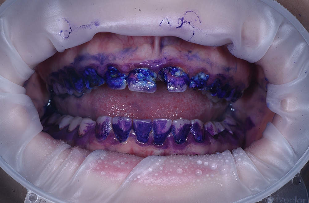 Первый визит к стоматологическому гигиенисту в 20 лет