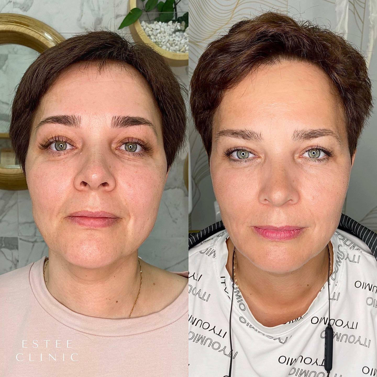 Чкалова 34. Estee clinic университетская. Лаеннек до и после. Estee clinic университетская ул. Больница лайн.