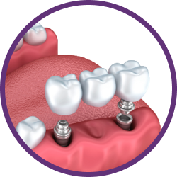 Установка имплантов в Дербенте. Имплантация при отсутствии одного зуба.