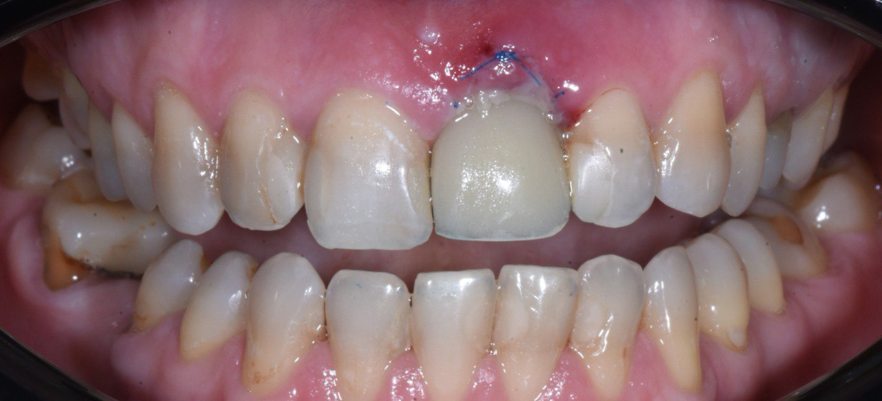 Имплантация сломанного переднего зуба с немедленным протезированием коронкой в зоне улыбки