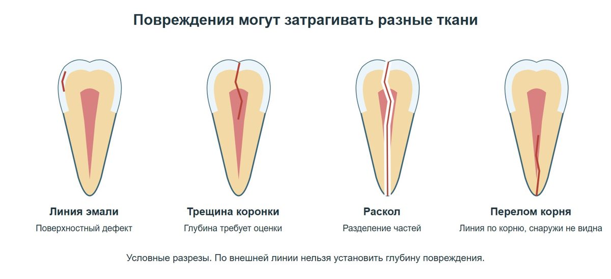 Поверхностная линия эмали и глубокие повреждения зуба