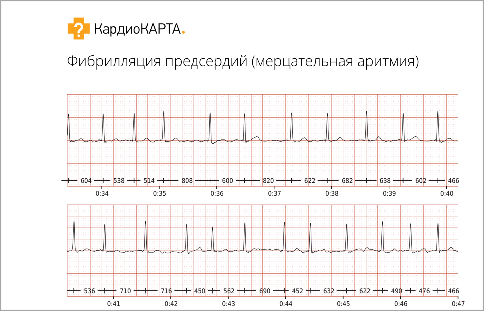 Внезапное сильное сердцебиение: тахикардия, аритмия или не причина для  беспокойства? | КардиоКВАРК