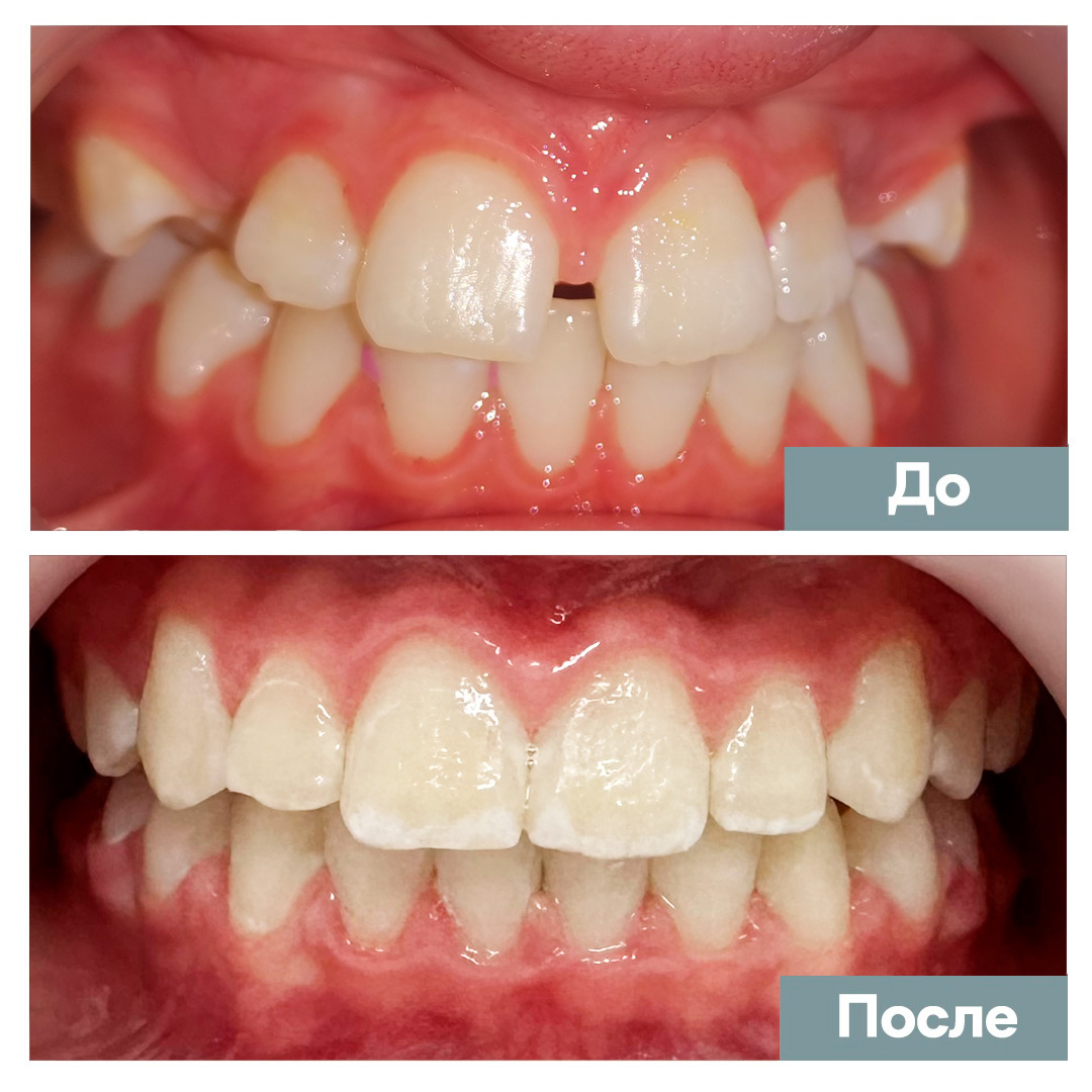 Выравнивание зубов и исправление прикуса у ортодонтов