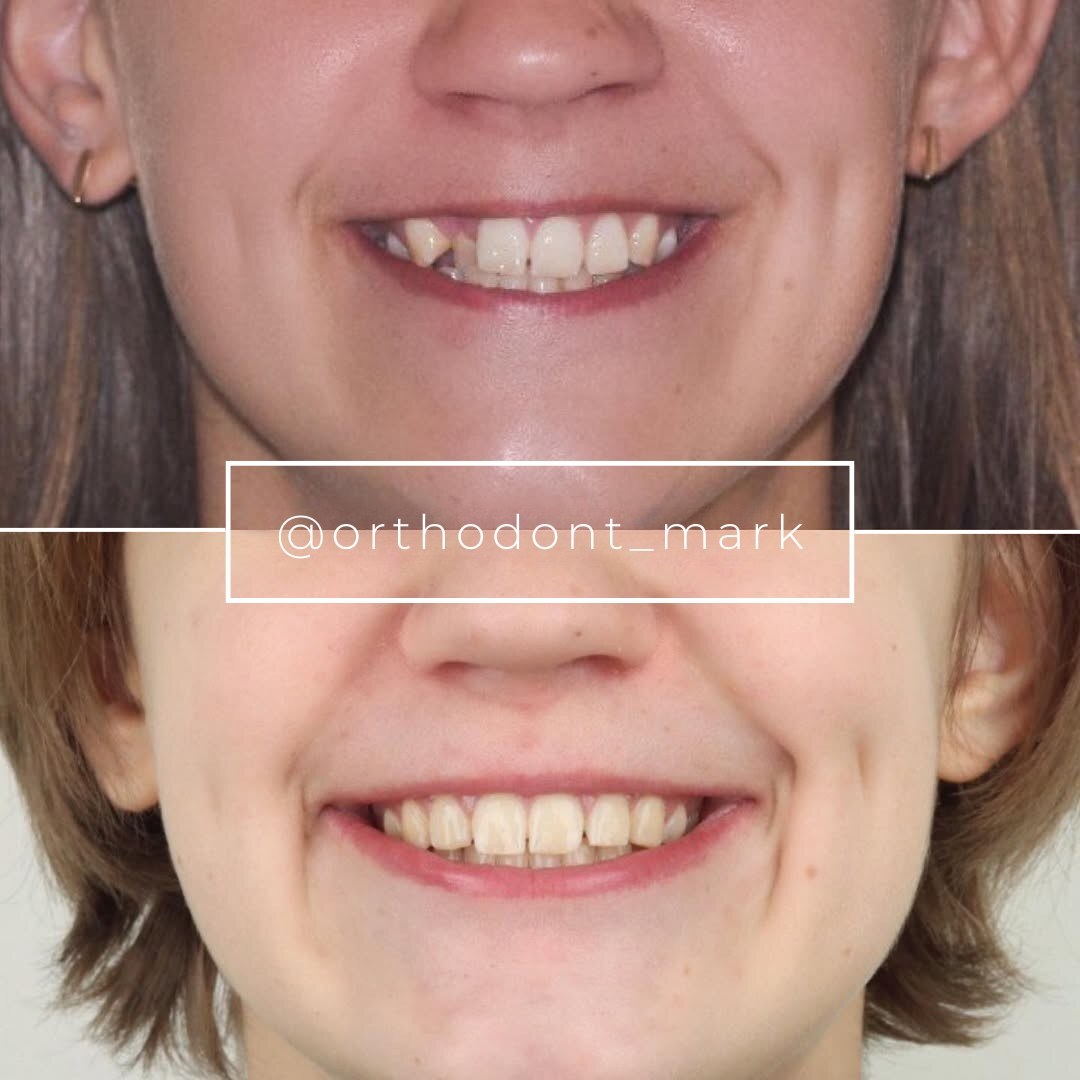 Narrow Arches, Crowding, and Midline Correction with Braces