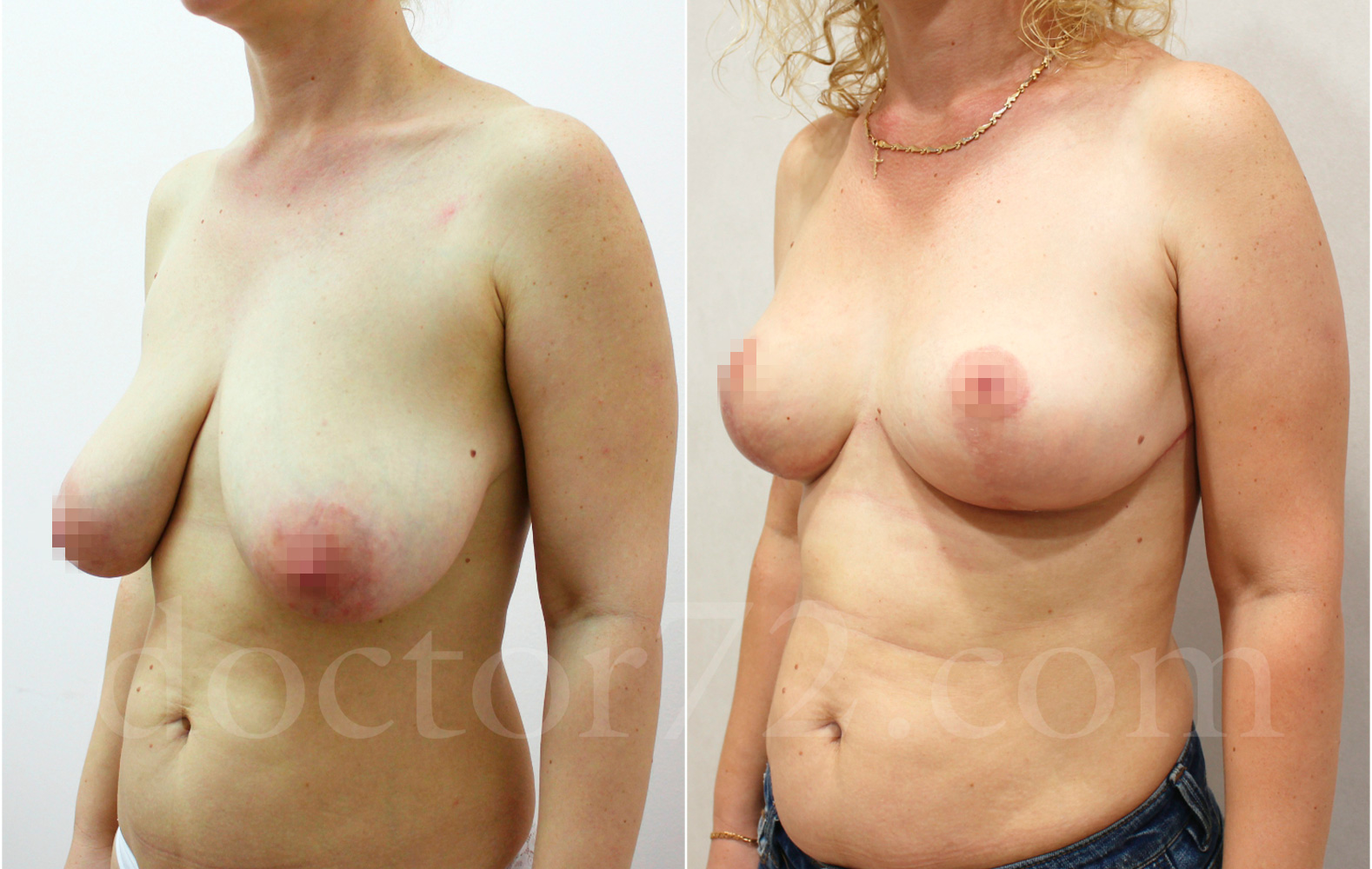 операция по подтяжке груди у женщин фото 90