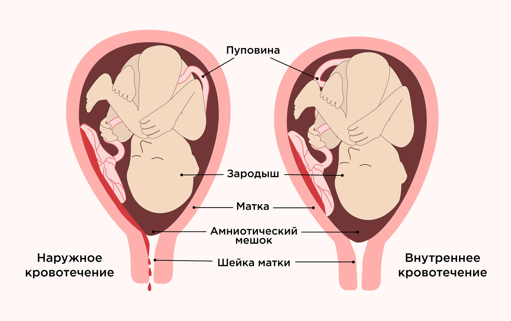 оргазм и гипертонус матки при беременности фото 65