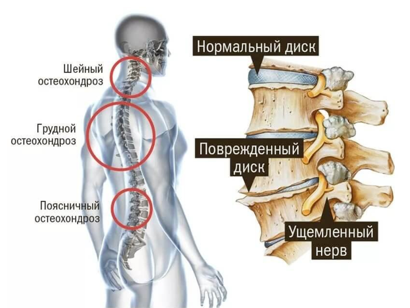 Остеохондроз