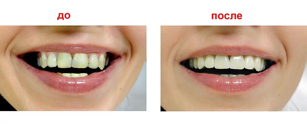 Фотографии зубов до и после стоматолога