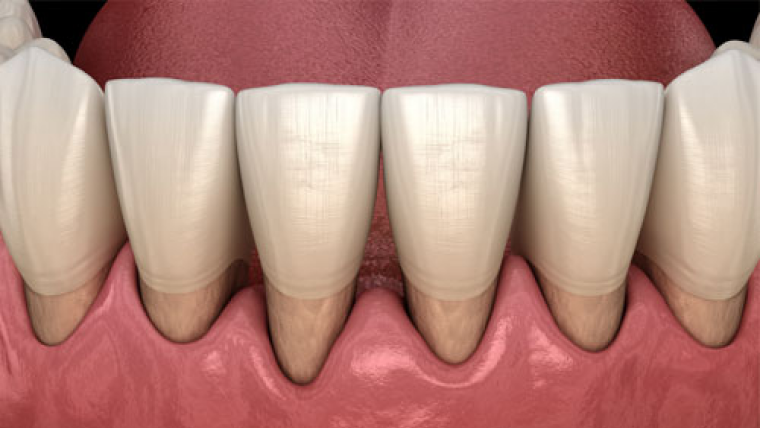 Лечение пародонтоза — цены в Дербенте. Стоматология DK