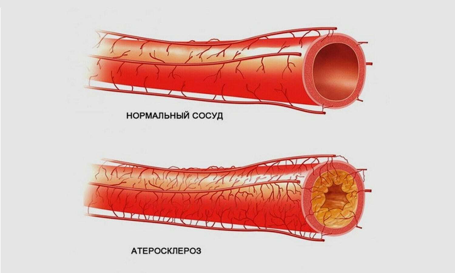 Как лечить сосуды