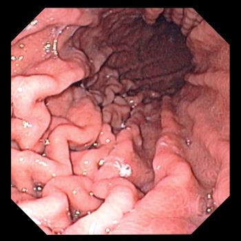 Эндоскопическое удаление полипов желудка