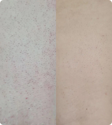 лазерная эпиляция до после