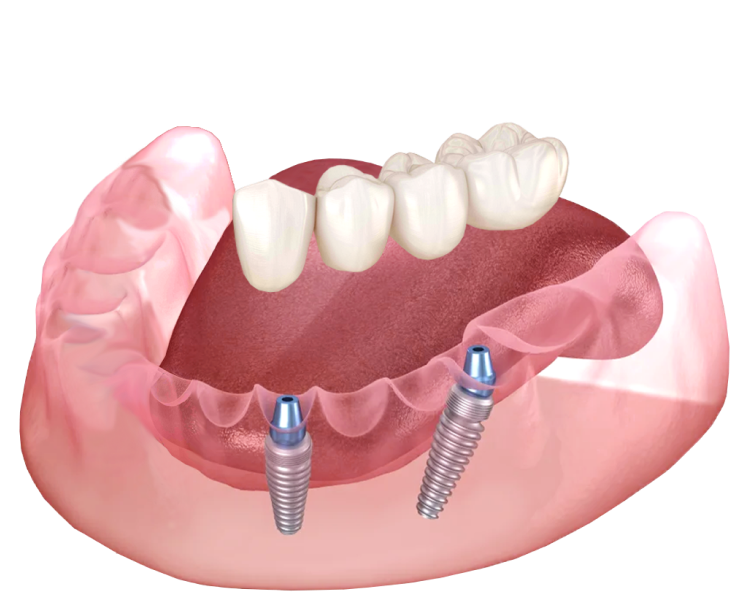 2 импланта — до 4 единиц