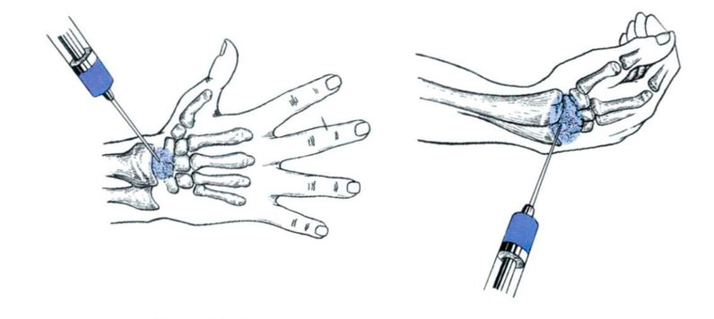 Канал блокада. Пункция лучезапястного сустава методика. Пункция локтевого сустава. Блокада запястного сустава. Блокада лучезапястного сустава техника.