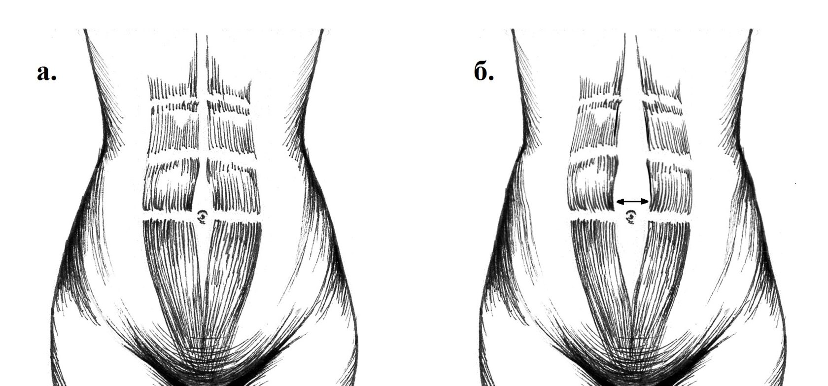 Расположение прямых мышц живота в норме и при диастазе прямых мышц живота