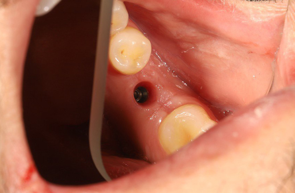 Лечение вторичной адентии зуба методом имплантации с установкой циркониевой коронки на винтовой фиксации