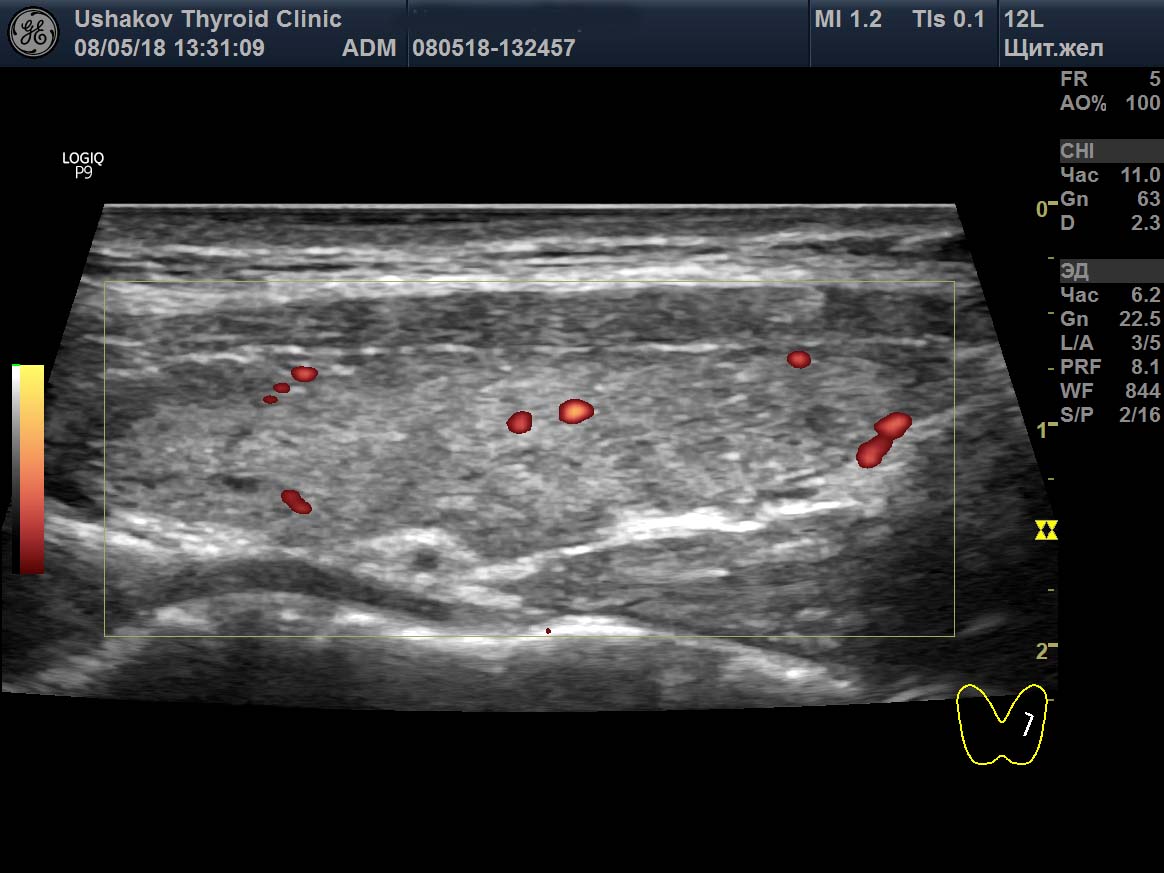 Лев узи. УЗИ брюшной полости и щитовидной железы. УЗИ абдоминальное щитовидной железы что это. Дополнительная доля щитовидной железы УЗИ.