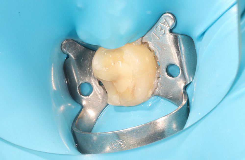 Восстановление целостности сколотой стенки зуба с сохранением анатомии