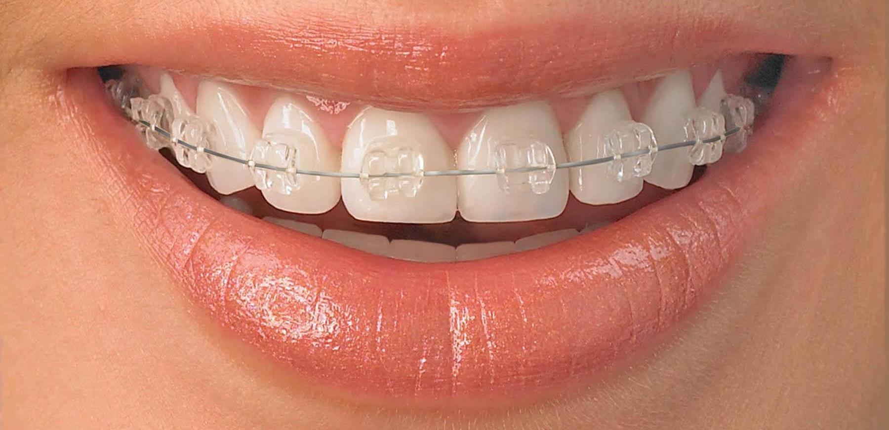 Выравнивание зубов без брекетов