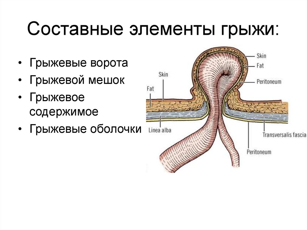 Бедренная грыжа фото