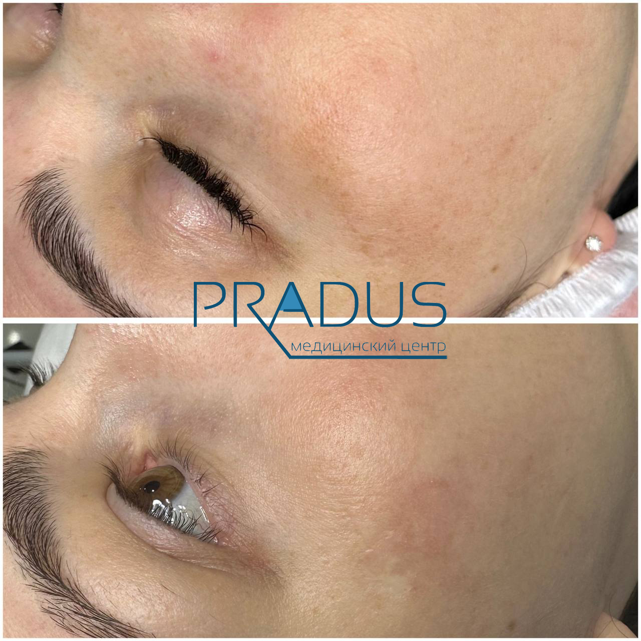Фото до и после: удаление пигментации лазером в клинике PradusCOSMO, Санкт-Петербург. Безопасная процедура с гарантией результата