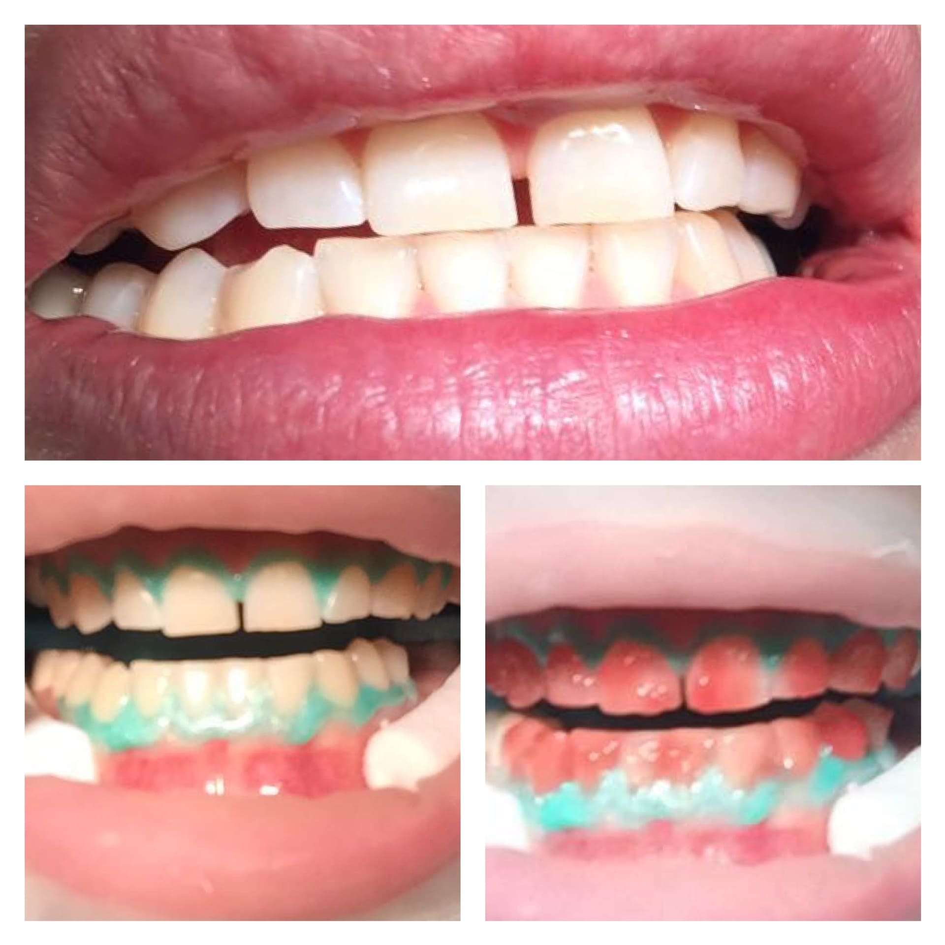 система opalescence отбеливание зубов отзывы
