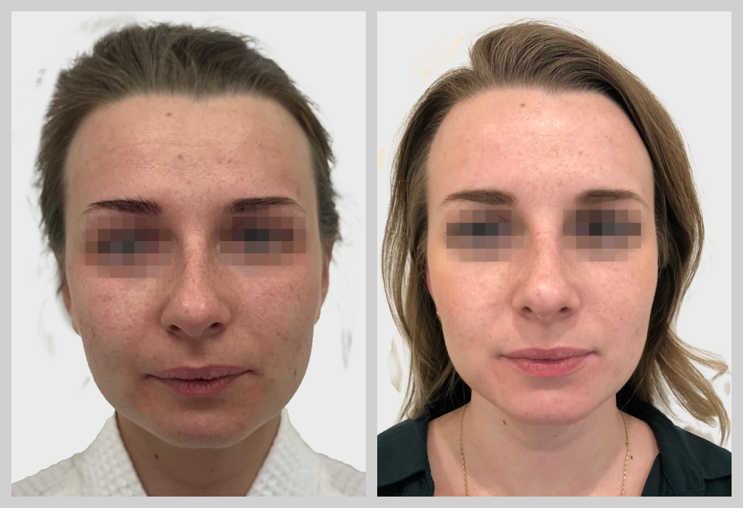 ринопластика пластическая хирургия