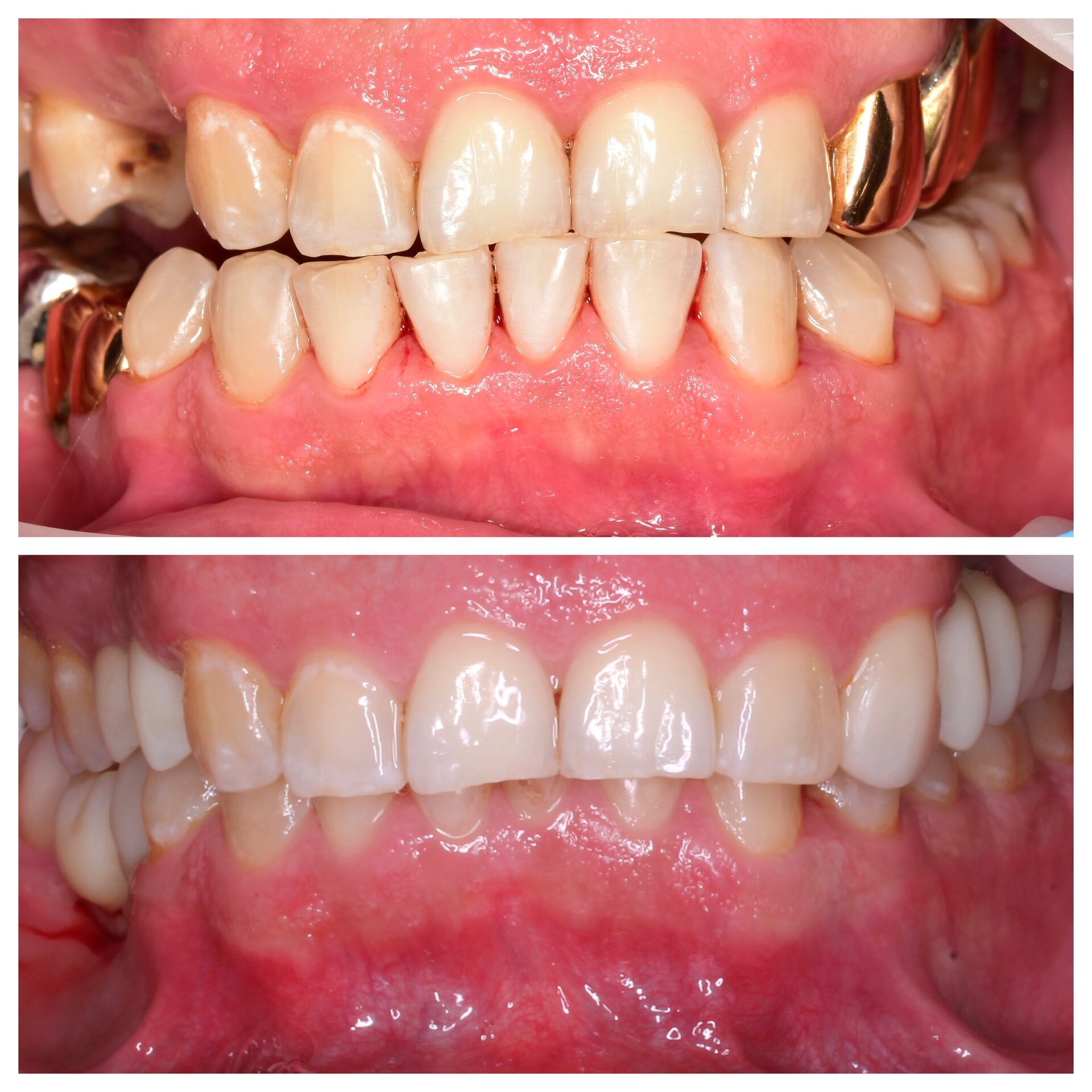 имплантация зубов чебоксары,имплантация зубов йошкар-ола,тотальная реабилитация на 6 имплантатах,протез несъемный в чебоксарах