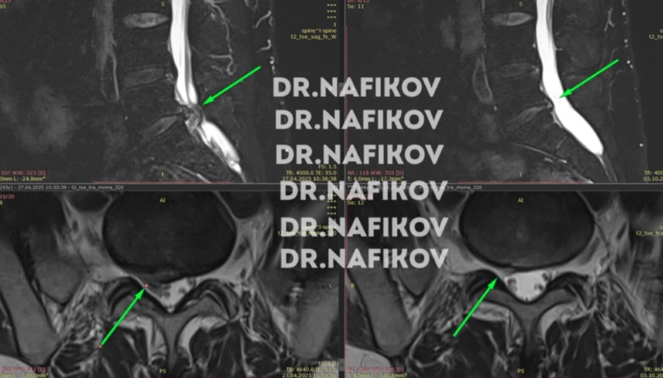 Контрольное МРТ, Пациент Ш., 43 года