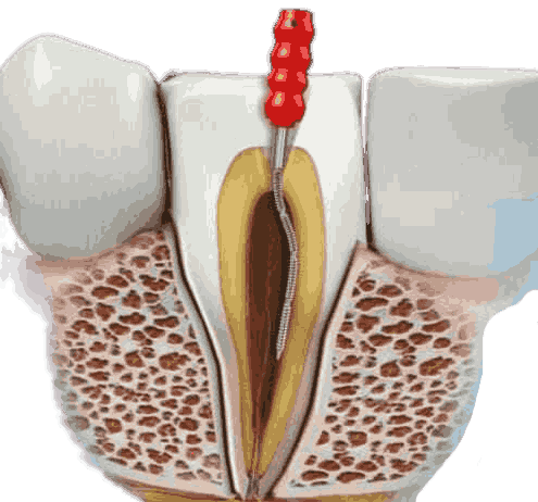 Лечение кариеса зубов в клинике доктора Барышева