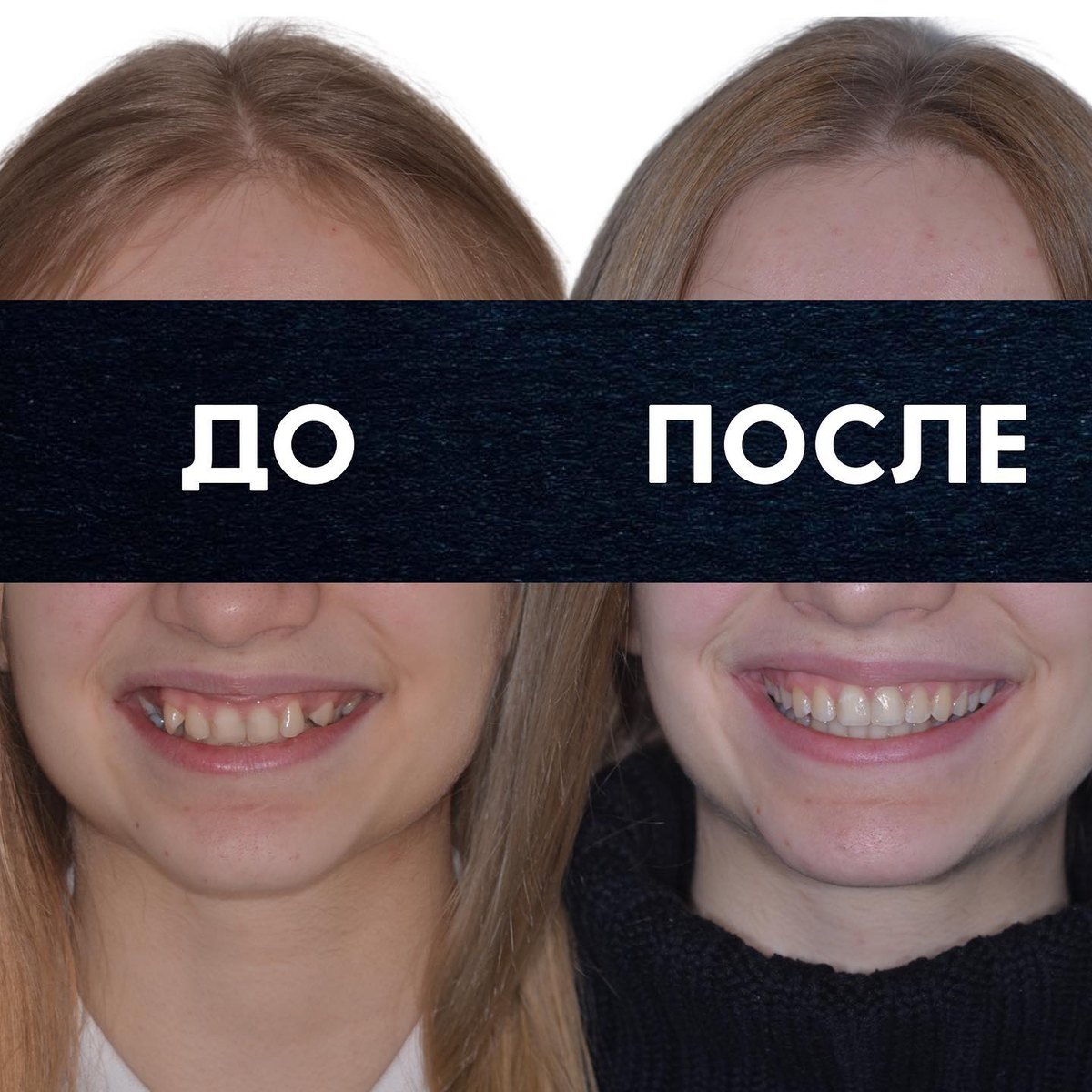 Глубокий прикус в сочетании с перекрёстным — клинический случай, врач Раджабов Марк, стоматология АааМ