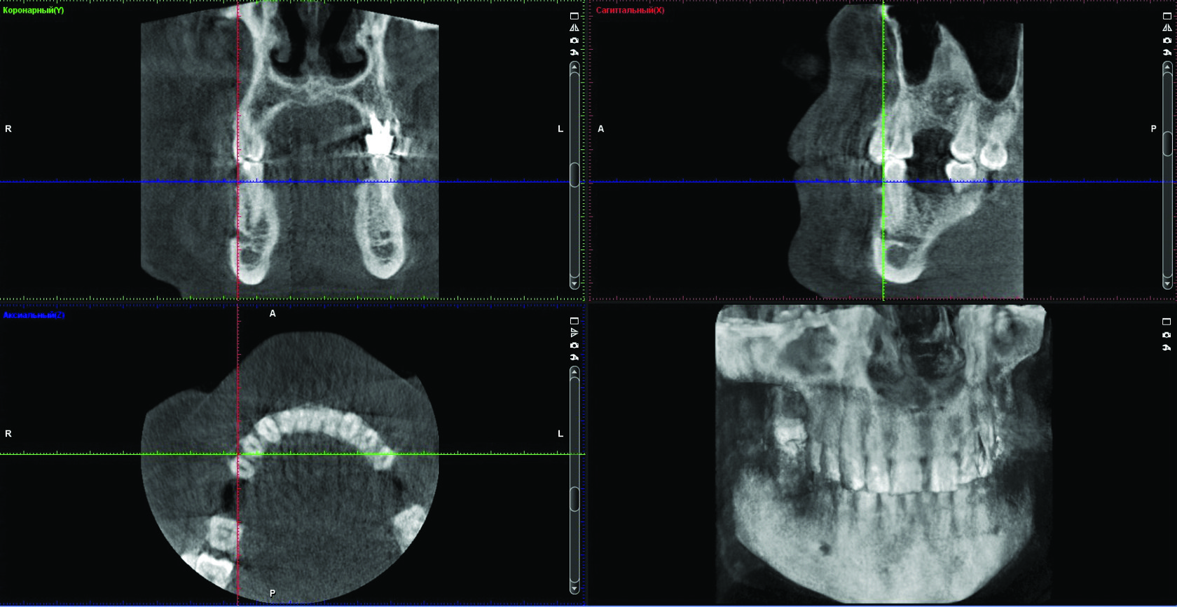 Радикулярная киста оптг. Спиральная кт конусно лучевая кт. Клкт мскт. Конусно-лучевая компьютерная томография (клкт). Мскт и клкт.
