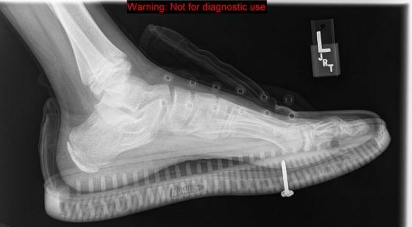 Инородное тело металлической плотности. Удаление инородного тела мягких тканей. Удаление инородного тела мягких тканей. Инородные тела мягких тканей на рентгене. Инородное тело в мягких тканях.