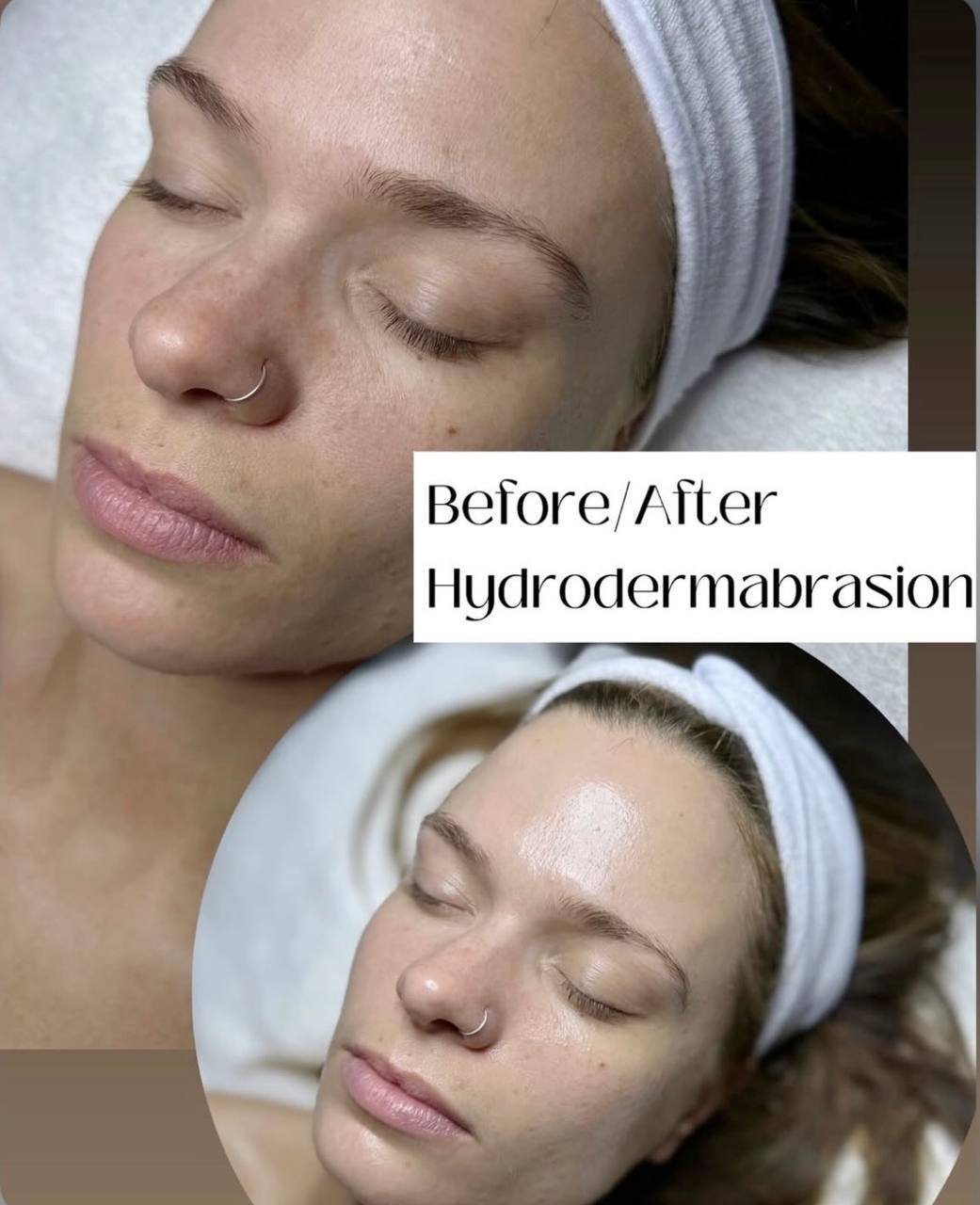 HydroDermabrasion before and after hydrated glowing skin Beauty Studio by Hanna Mount Pleasant SC