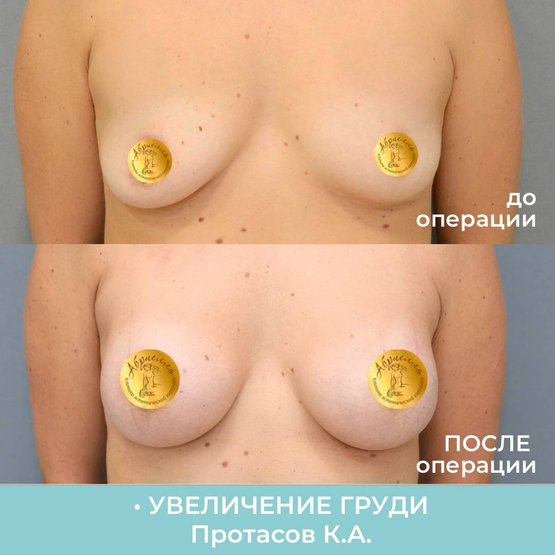 почему у женщин увеличивается грудь фото 28