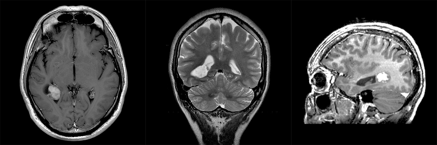 расширение субарахноидального пространства кт. рассеянный склероз оптикомиелит девика. мозжечковая атаксия на кт. субарахноидальное конвекситальное пространство расширено на кт. мрт больших полушарий.