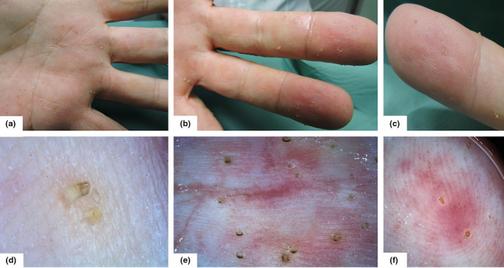 Шиповидная кератодермия ладоней и подошв
