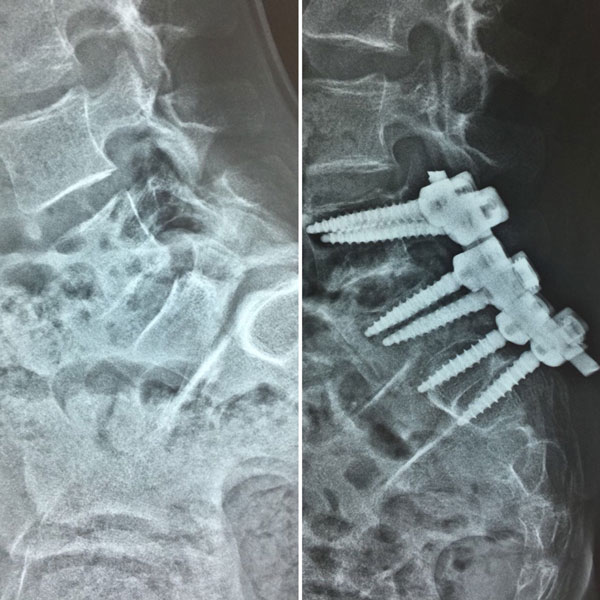 Лечение спондилолистеза у детей и взрослых. Операции при спондилолистезе