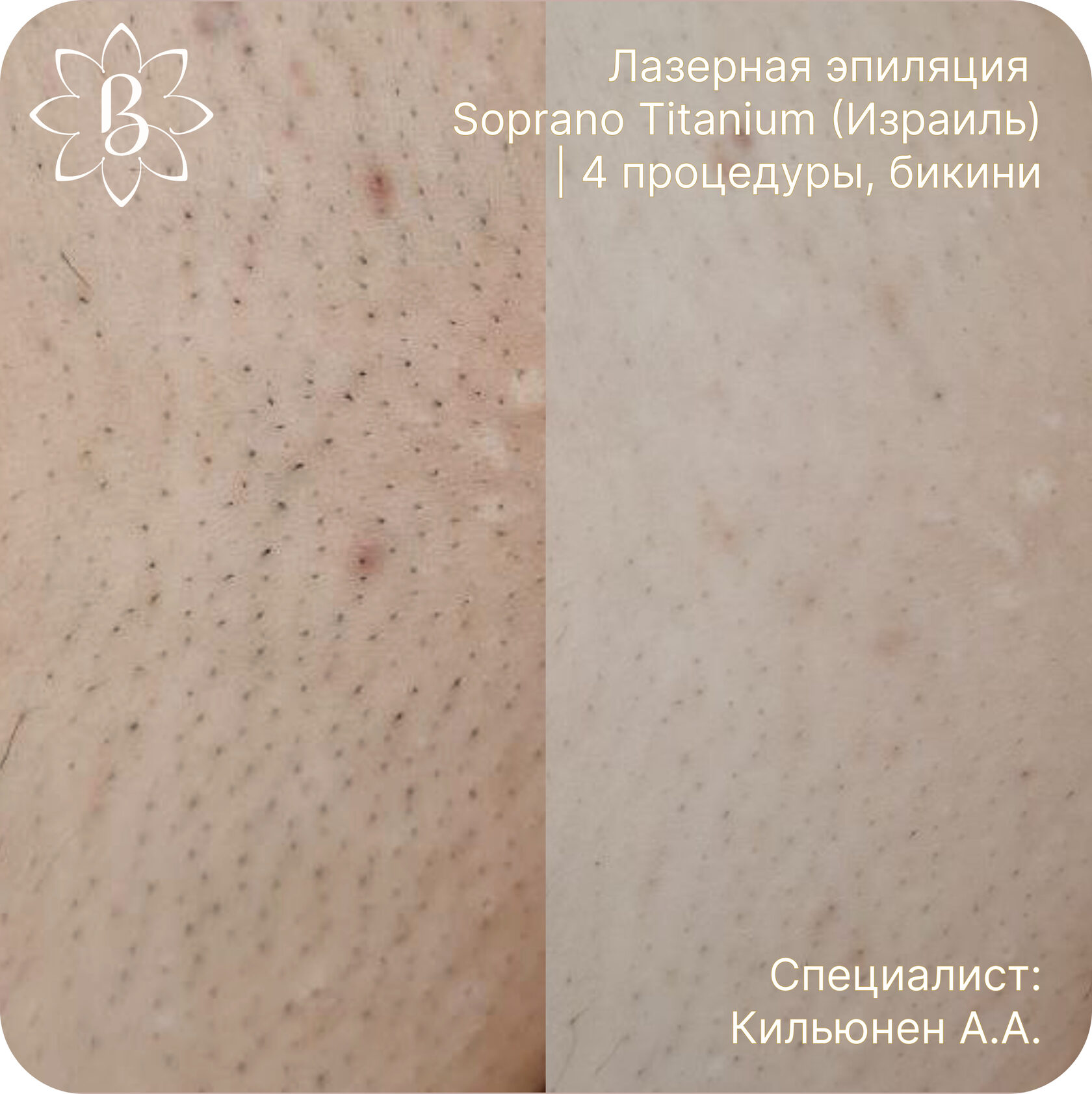 лазерная эпиляция до после