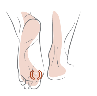 Вартокс® крем-паста от подошвенных бородавок. Официальный сайт