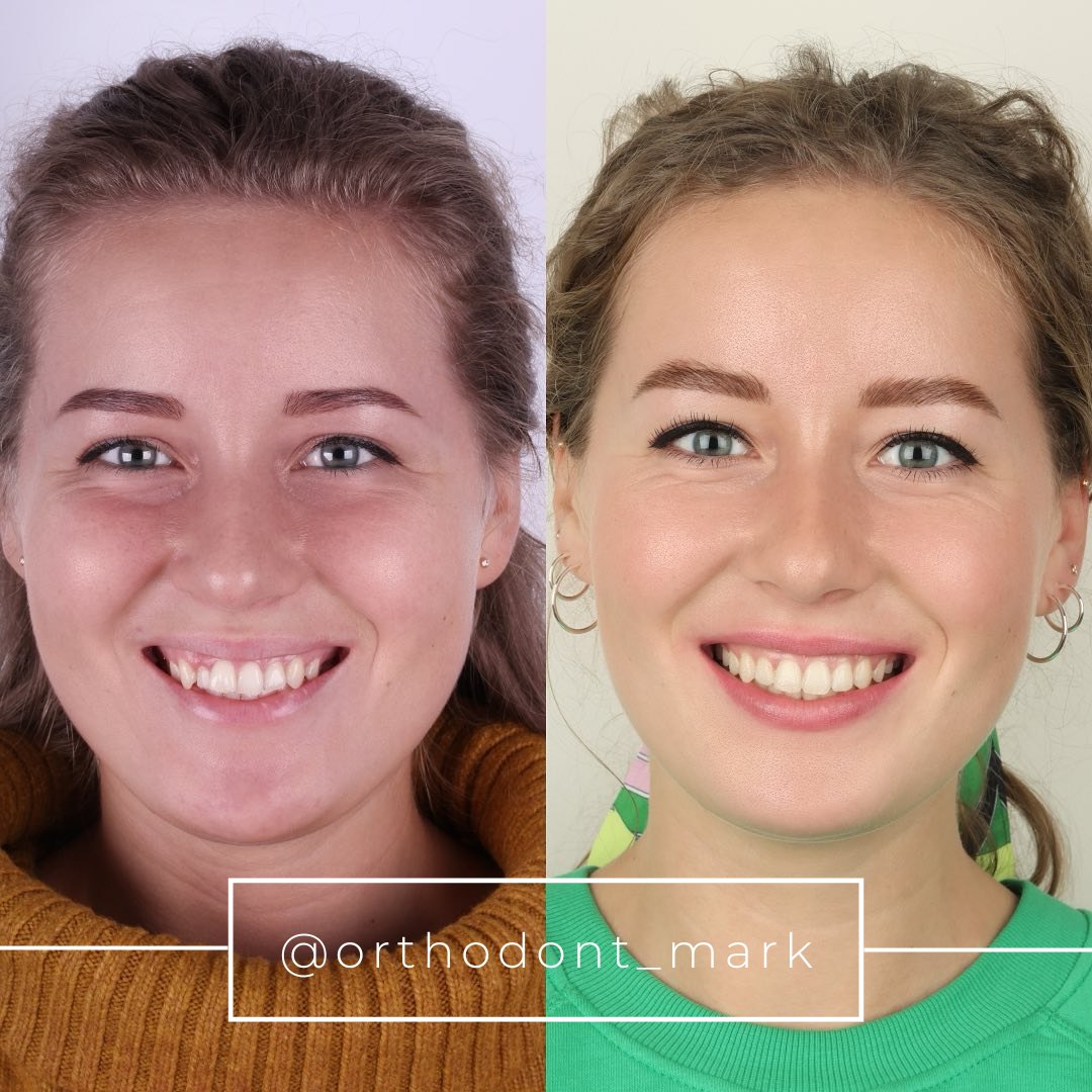 Before and after collage showing correction of distal bite and crowding over 25 months — photo 1 of 1