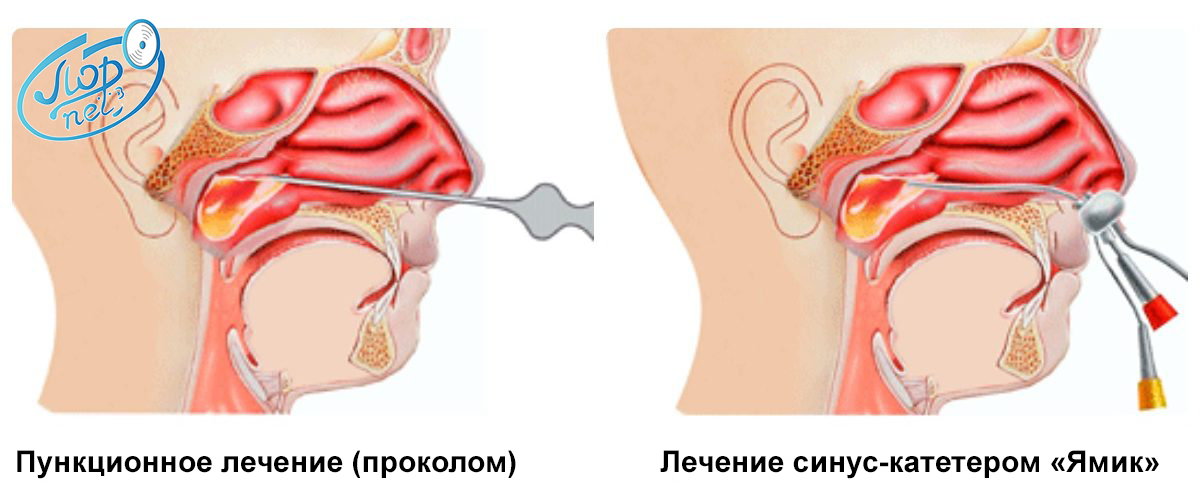 Лечение гайморита без