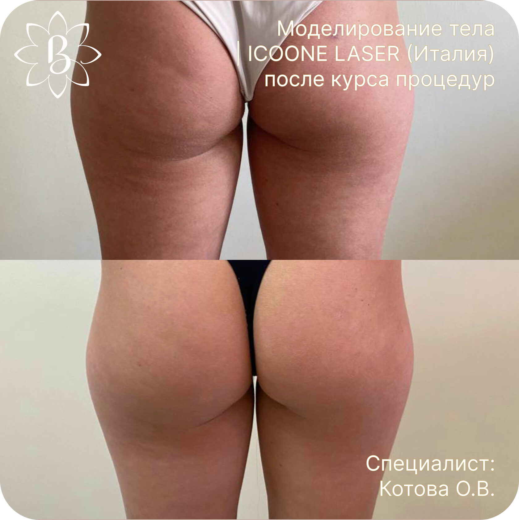 Диодная лазерная эпиляция СПб