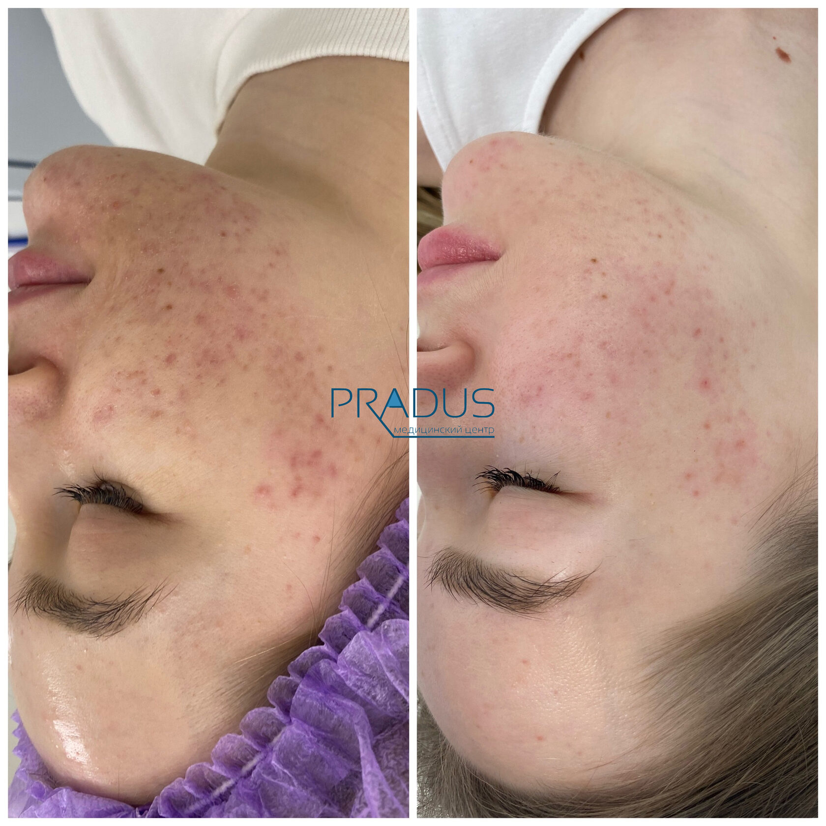 Лечение акне у женщины в клинике PradusCOSMO, СПб. До и после процедуры