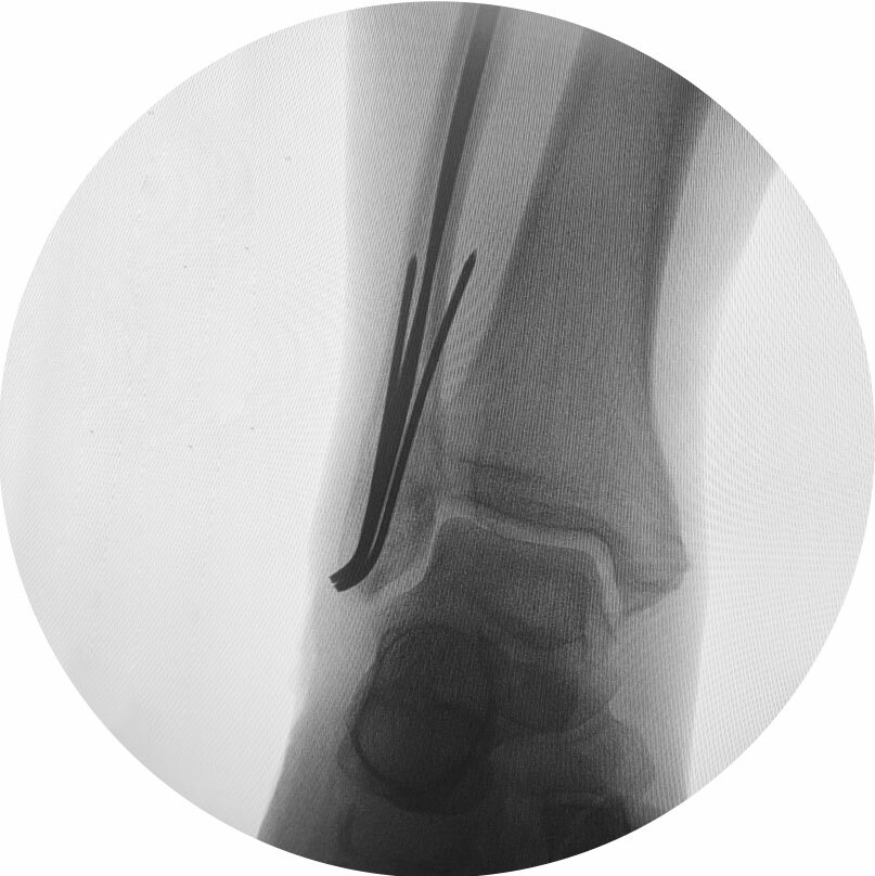 Лечение перелома лодыжки | L-Clinic