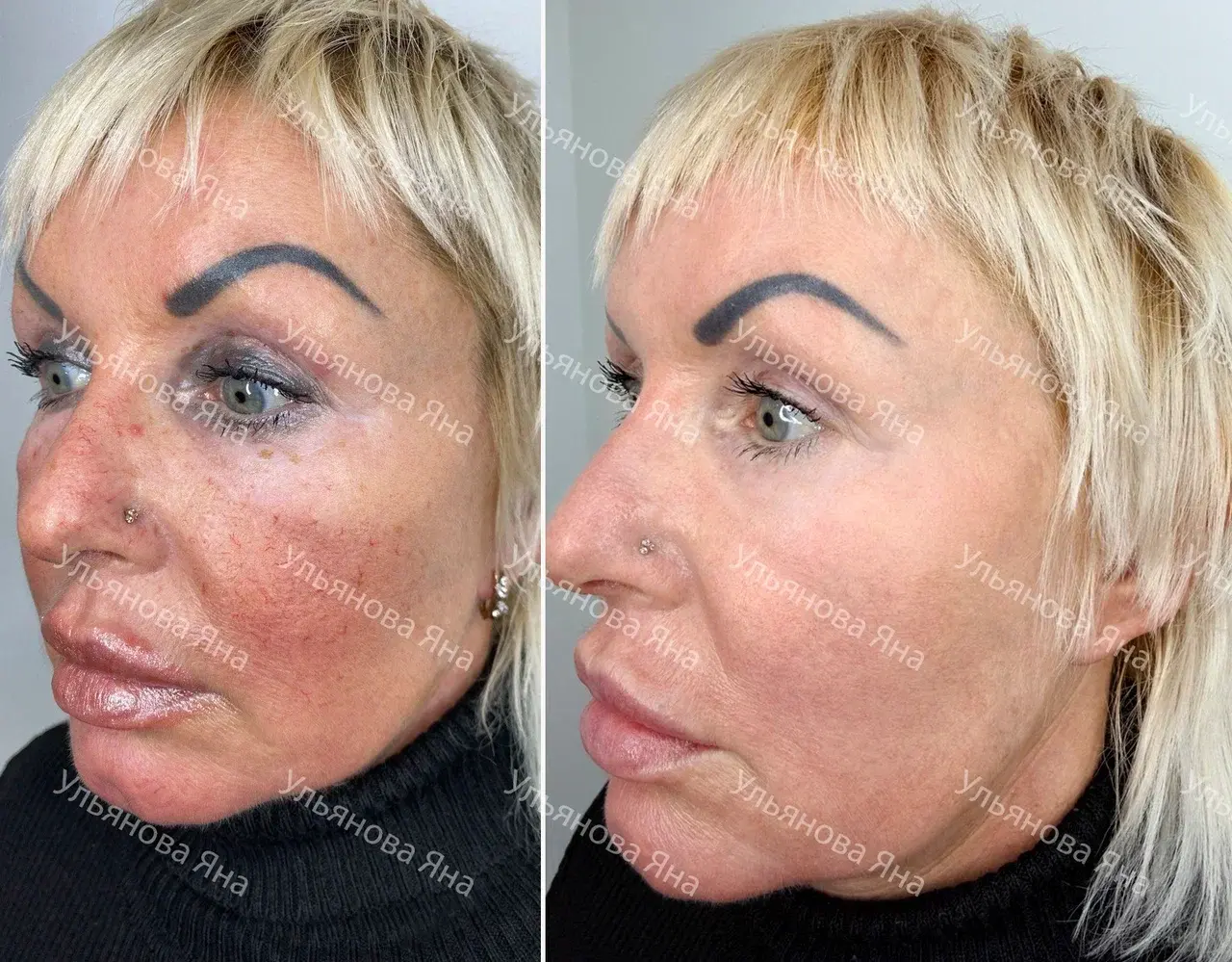Фотоомоложение и коррекция эстетических патологий