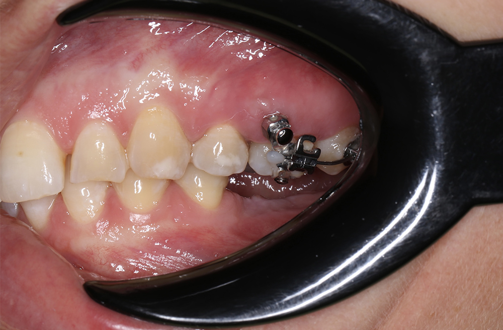 Внедрение зубов верхней челюсти для последующего протезирования